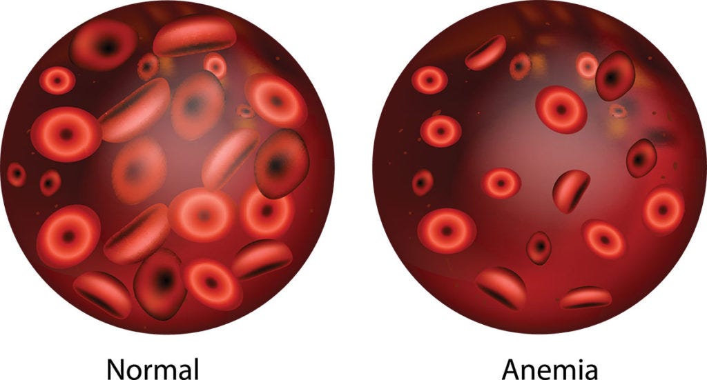 How To Recognize Sleep Apnea & Anemia